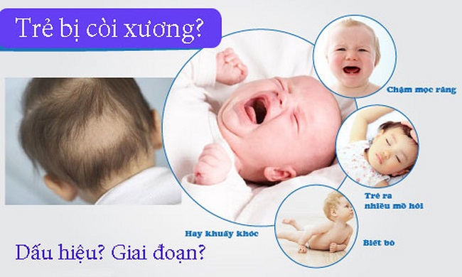 trẻ bị còi xương do thiếu vitamin d và canxi