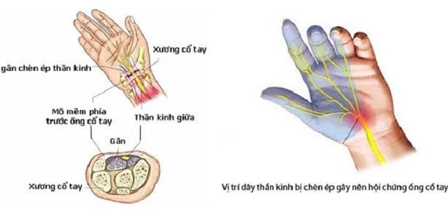 hội chứng ống cổ tay khi mang thai