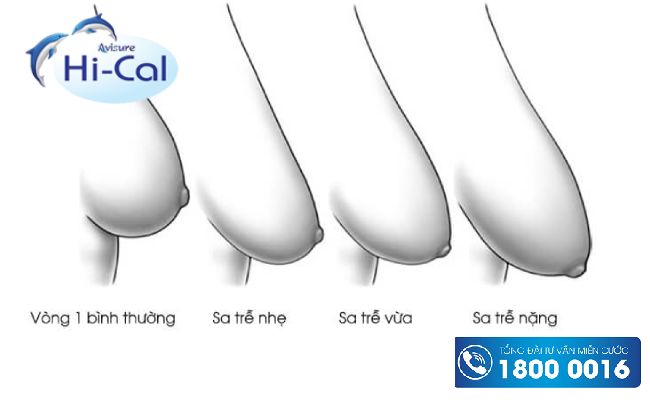 Vòng 1 sau sinh thay đổi như thế nào?