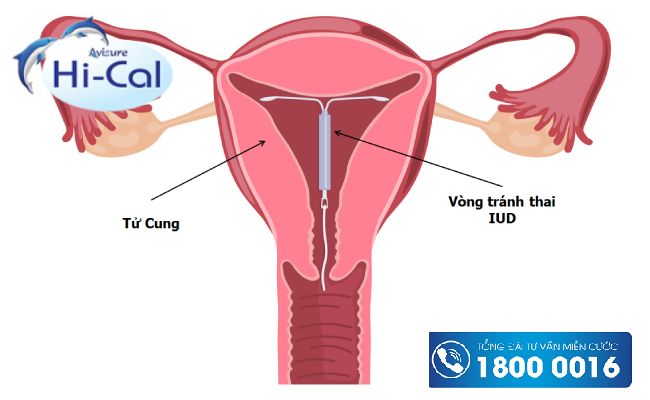 Sau sinh bao lâu đặt được vòng tránh thai