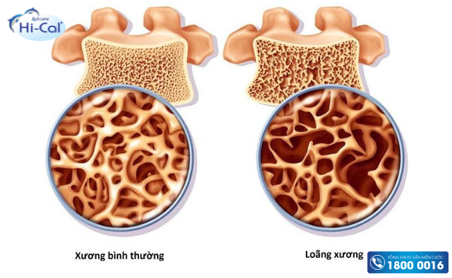 Loãng xương ở trẻ em